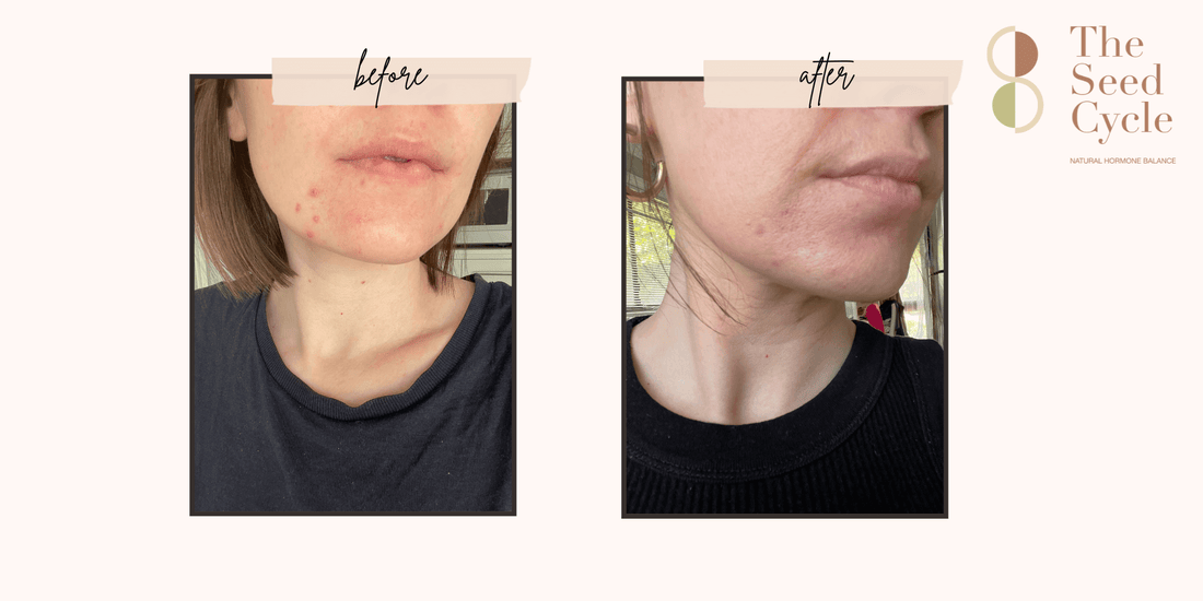 Seed Cycling: A Natural Approach to Managing Hormonal Acne